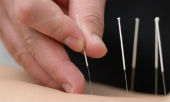 Image of acupuncture